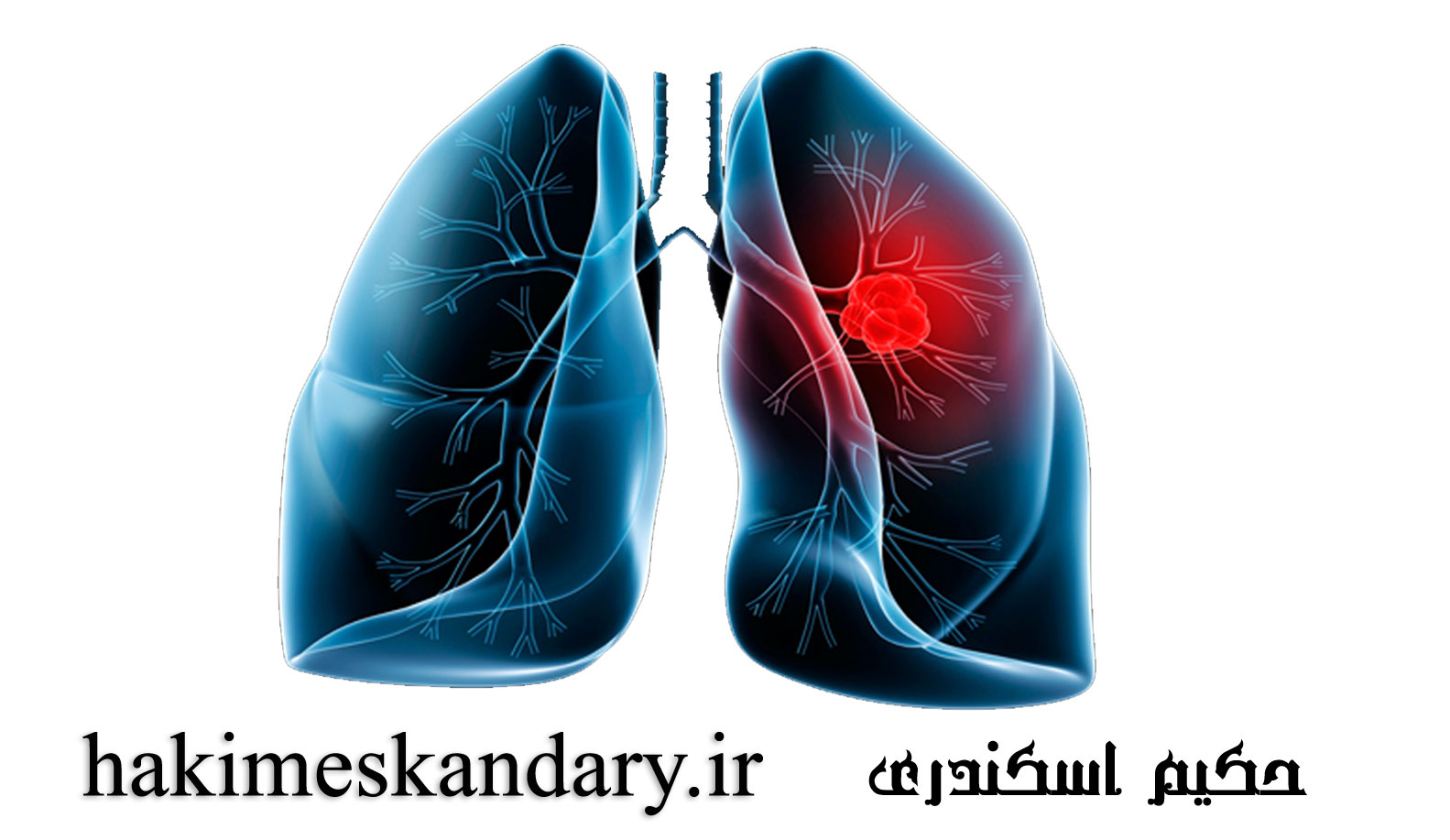 درمان گیاهی عفونت های ریوی