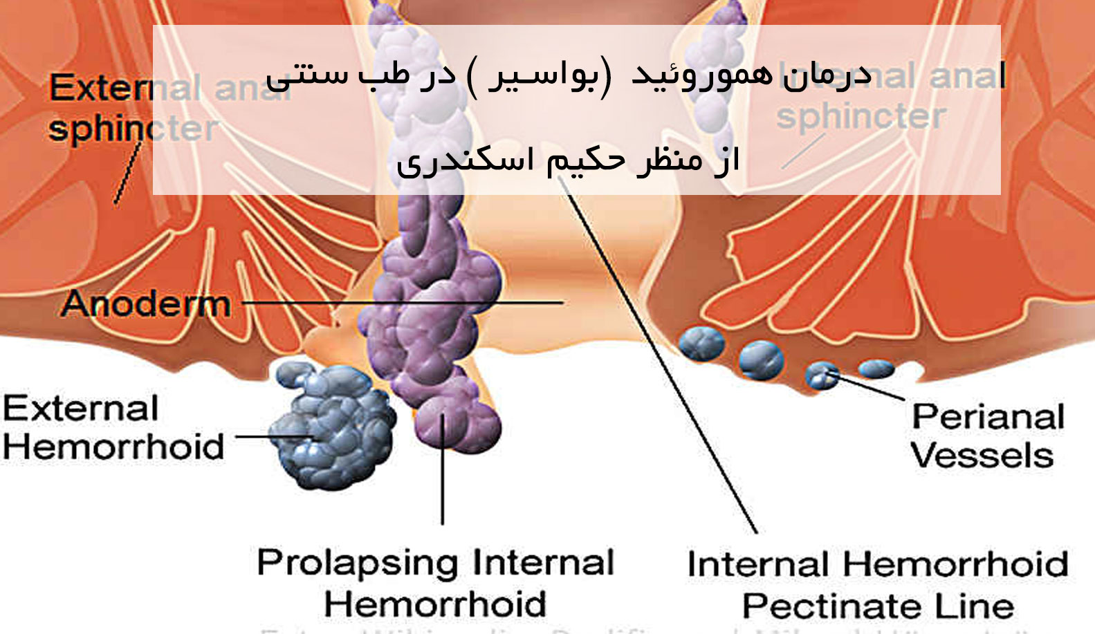 درمان هموروئید (بواسیر) در طب سنتی از منظر حکیم اسکندری