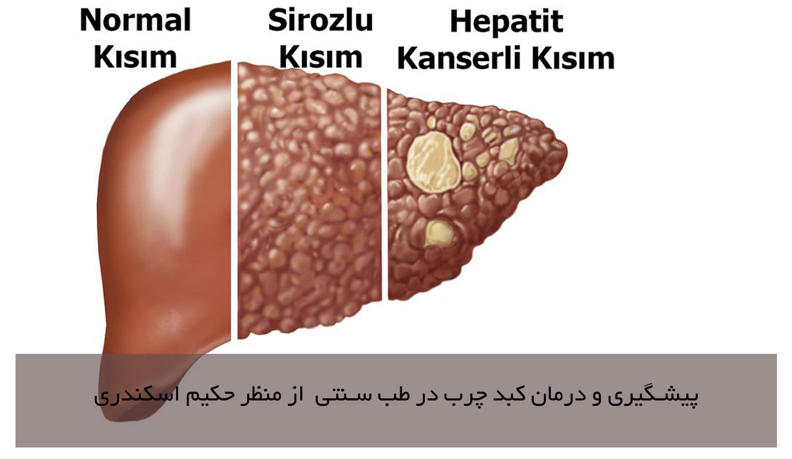 پیشگیری کبد چرب در طب سنتی