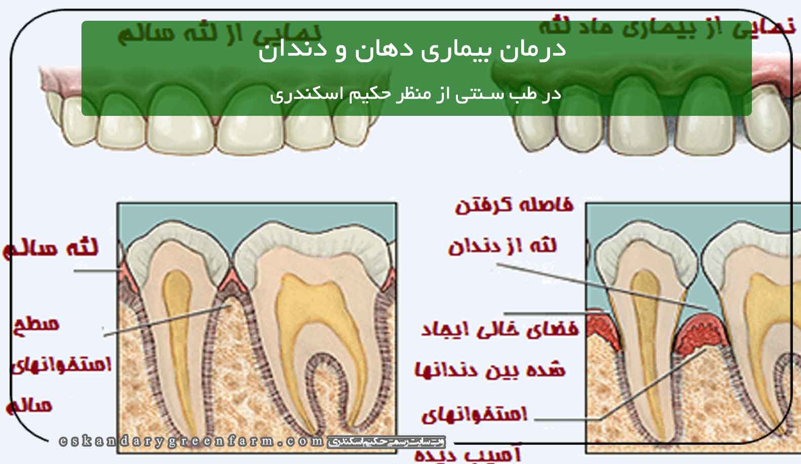 درمان بیماری دهان و دندان در طب سنتی