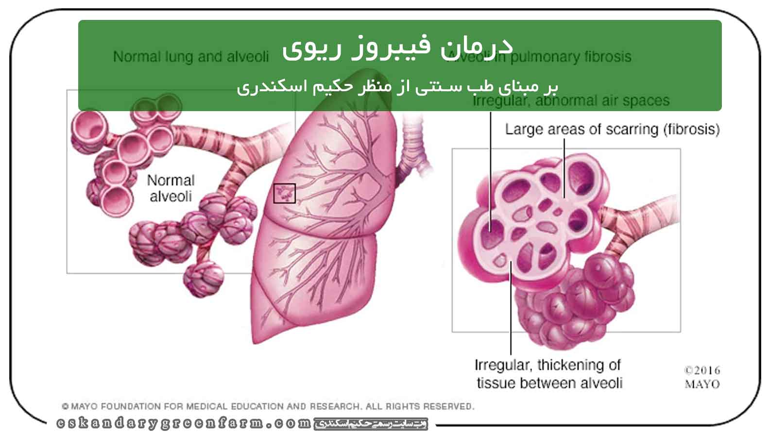 درمان فیبروز ریه در طب سنتی
