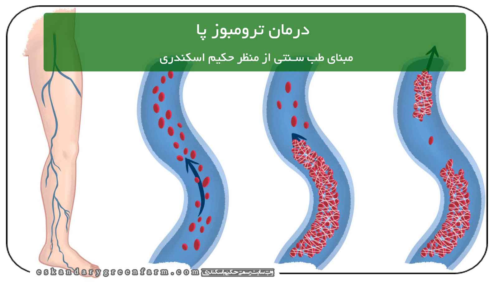 نسخه گیاهی درمان ترومبوز پا در طب سنتی