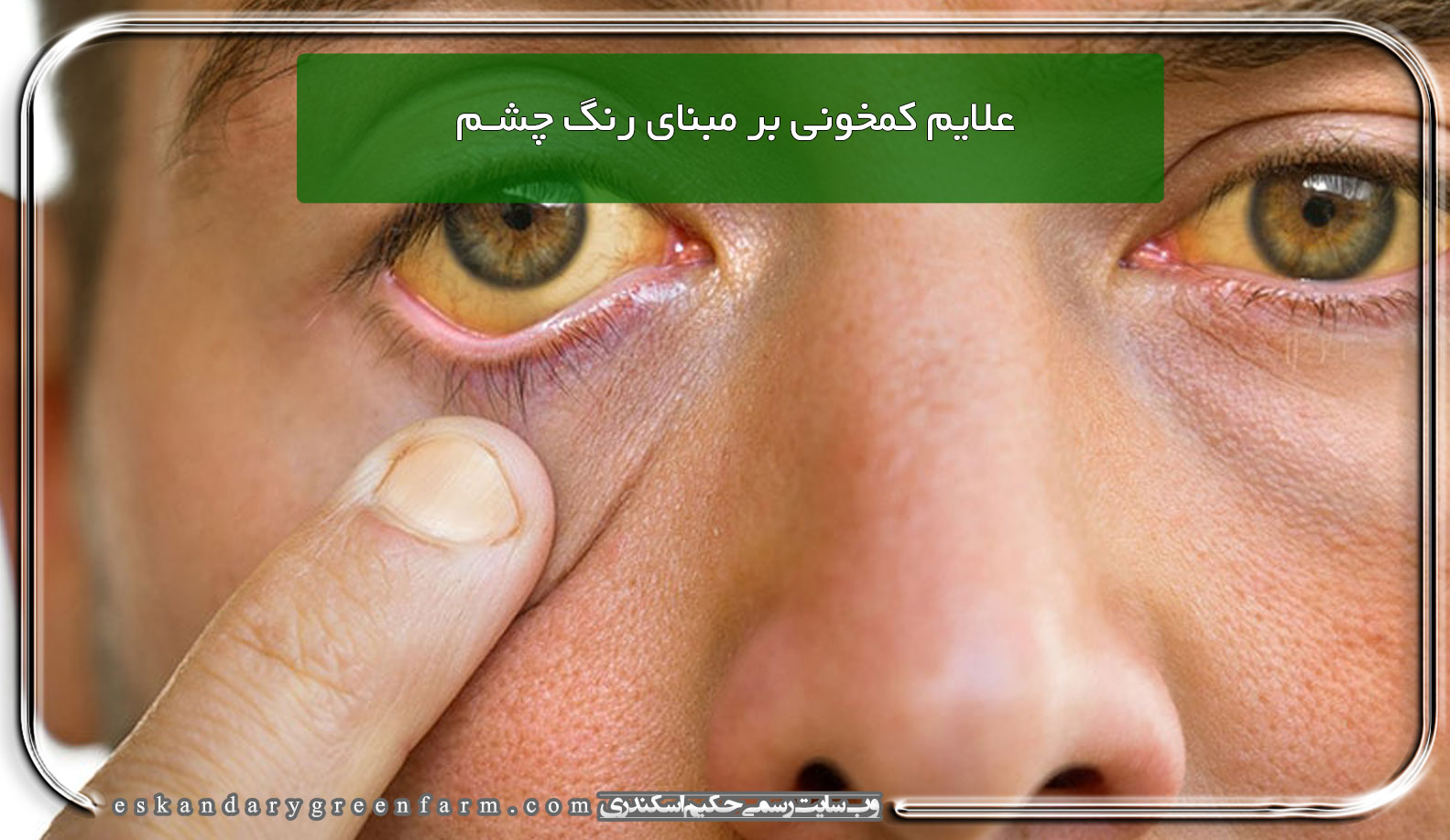 علایم کمخونی بر مبنای رنگ چشم
