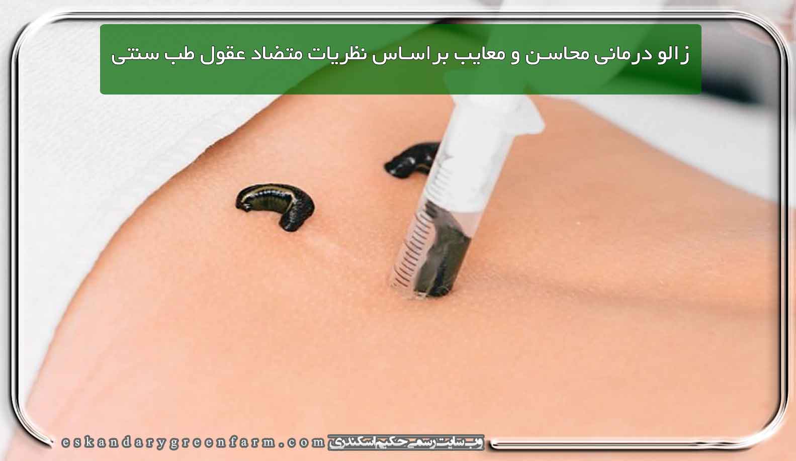 زالو درمانی محاسن و معایب براساس نظریات متضاد عقول طب سنتی