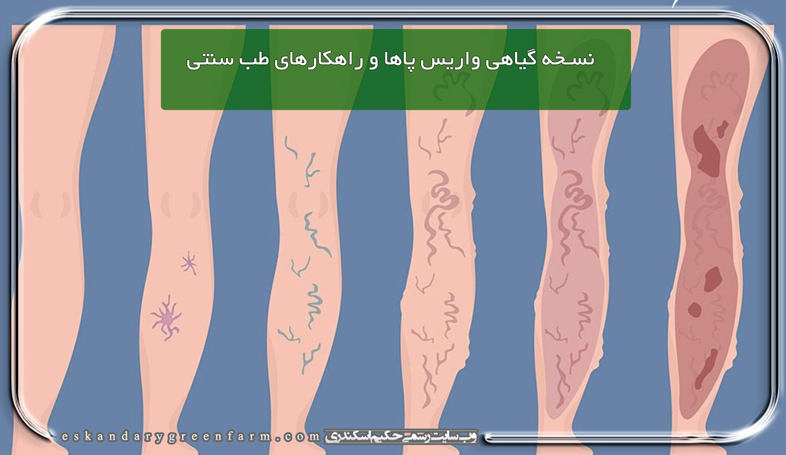 نسخه گیاهی واریس پاها و روش درمانی بر مبنای طب سنتی